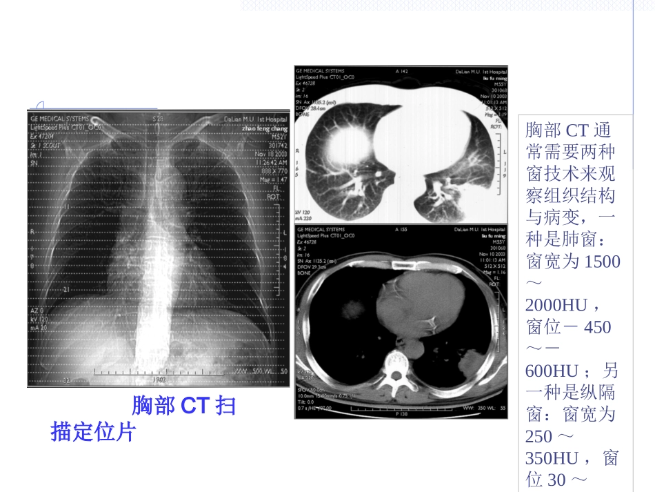 肺部CT技术_第3页