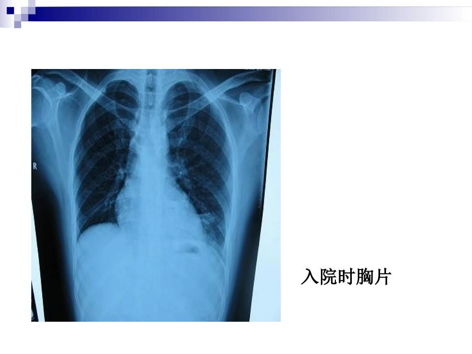 肺脓肿医学知识讲座优质课件_第2页