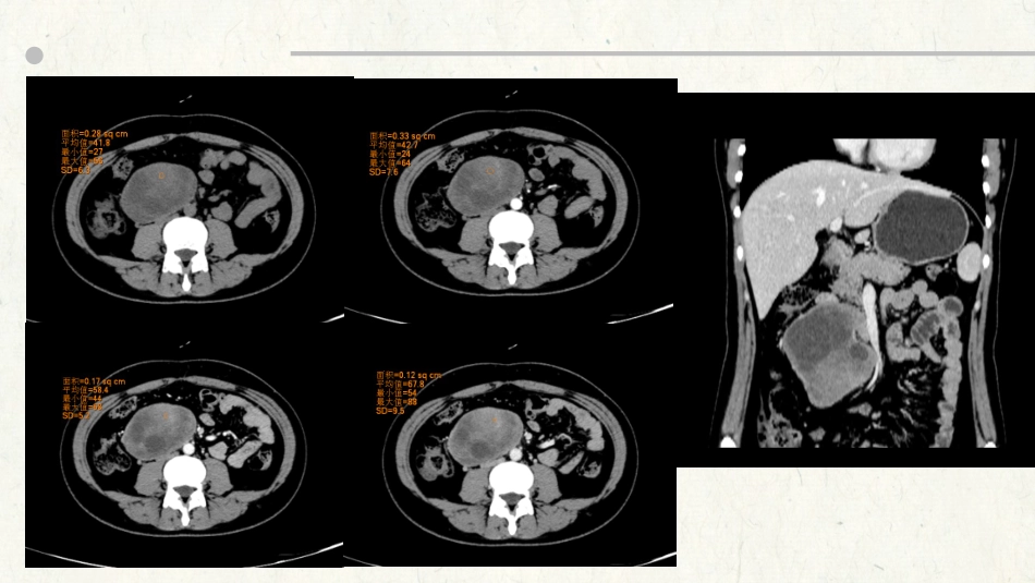 腹膜后神经鞘瘤_第3页