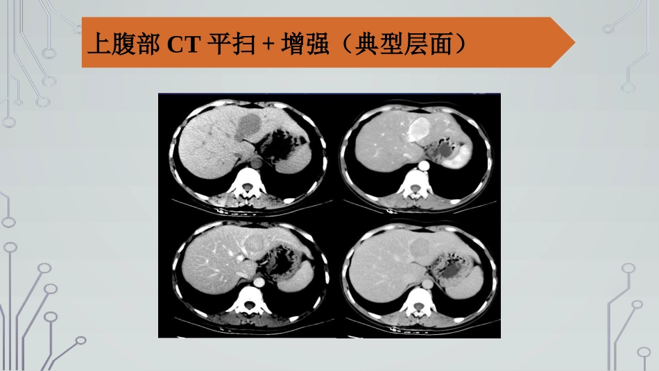 肝癌神经内分泌肿瘤_第2页