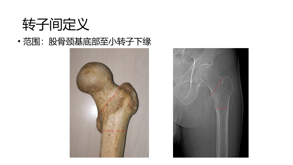 股骨粗隆间骨折分型_第3页