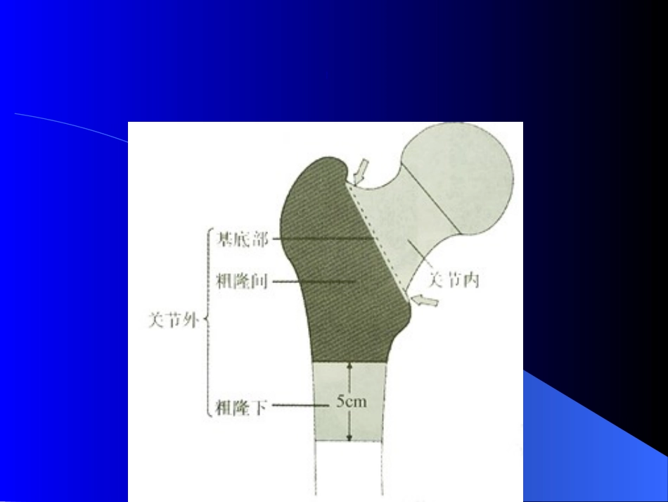 股骨粗隆间骨折优质课件_第3页