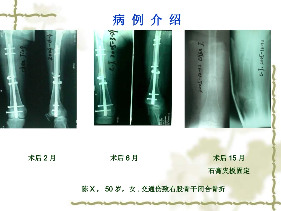 股骨干骨折不愈合的治疗概要_第2页