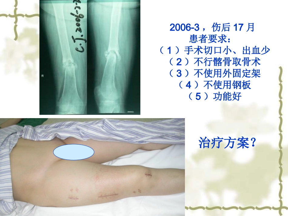 股骨干骨折不愈合的治疗概要_第3页