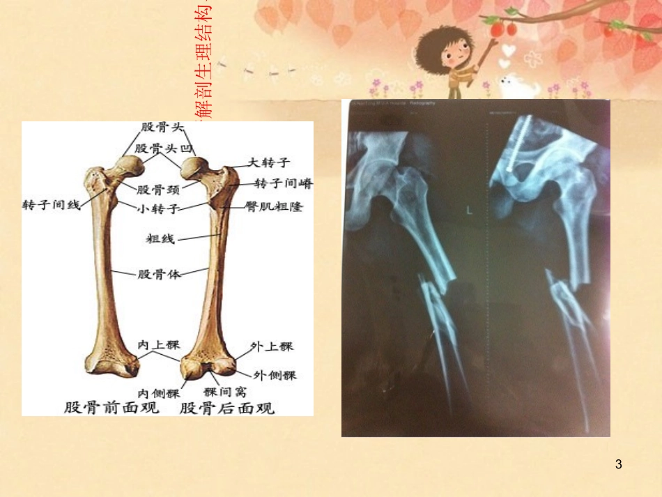 股骨骨折护理查房课件_第3页