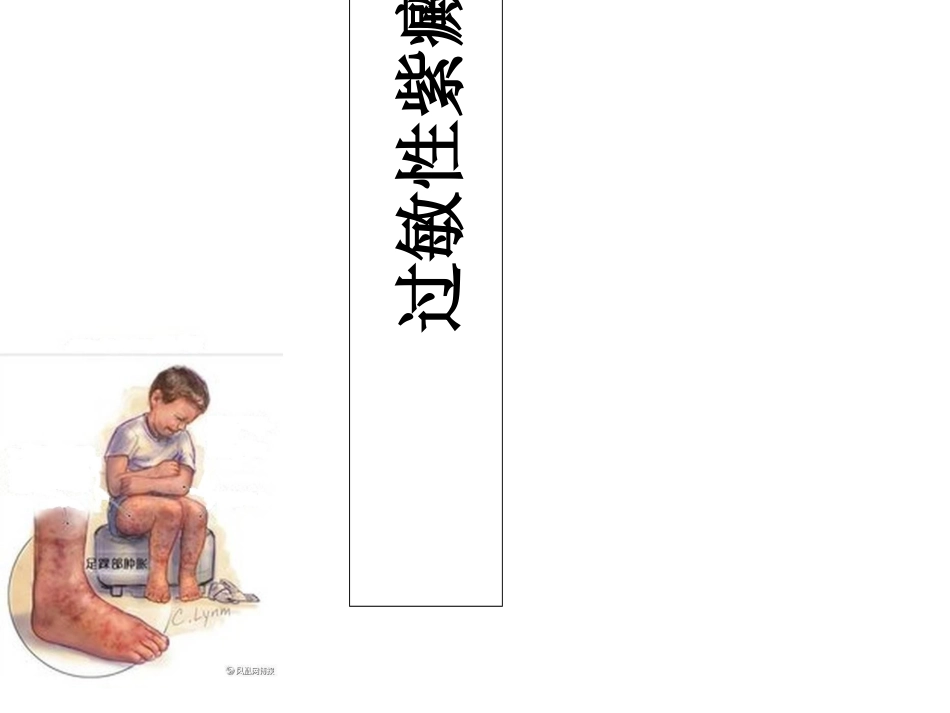 过敏性紫癜课件_第1页