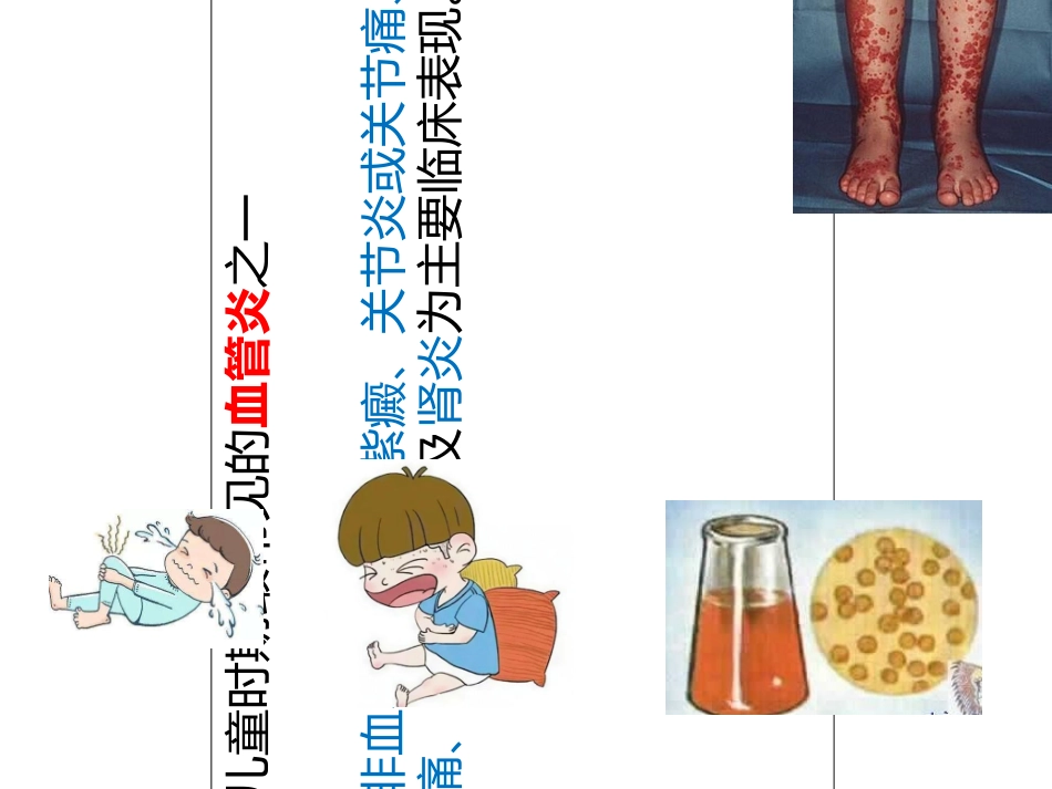 过敏性紫癜课件_第2页