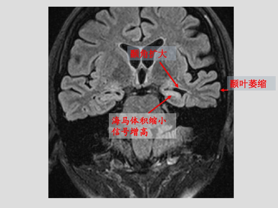 海马硬化的影像诊断最新_第2页