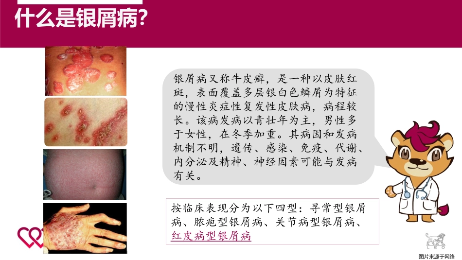 红皮型银屑病的护理_第3页