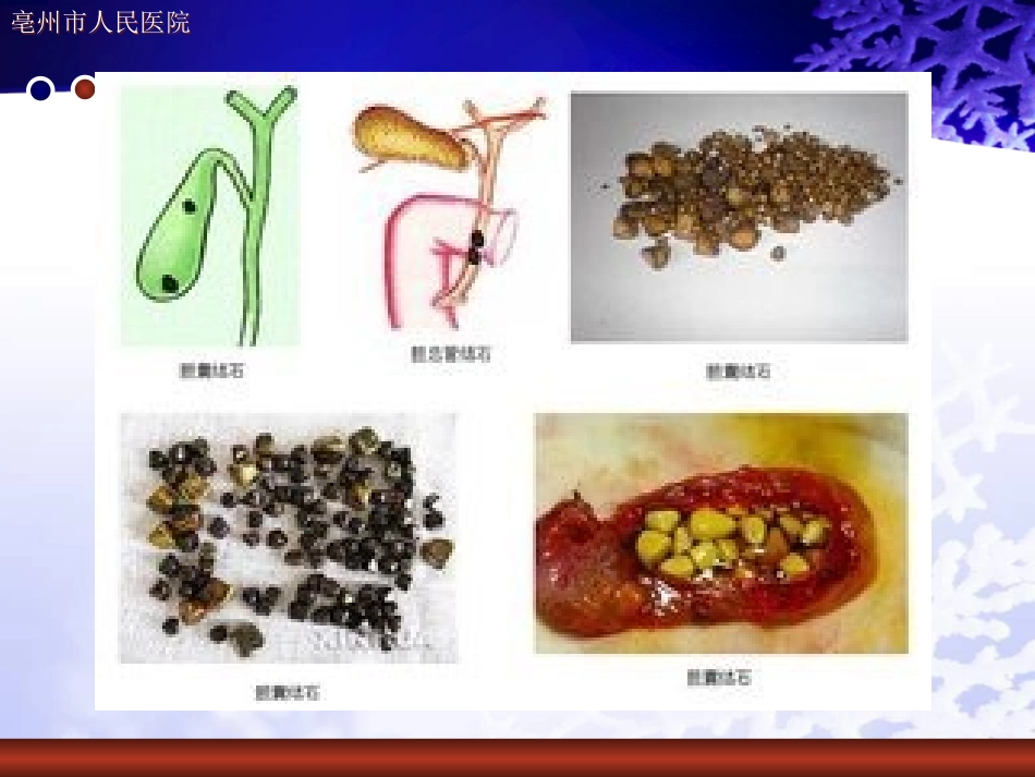 化脓性胆管炎的护理查房_第3页