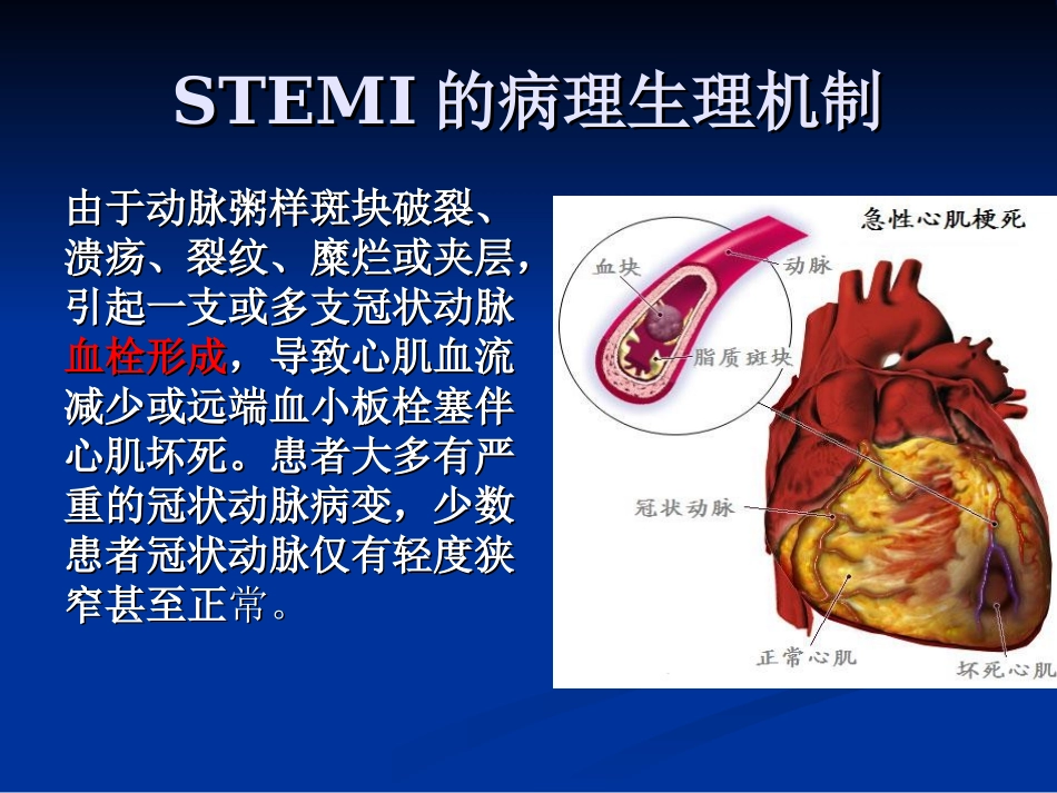 急性ST段抬高型心肌梗死诊断和治疗指南_第3页