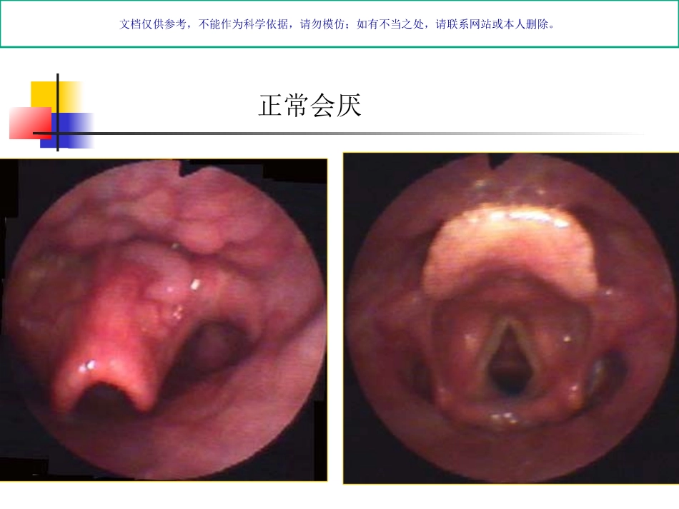 急性会厌炎专业医学知识宣讲课件_第2页