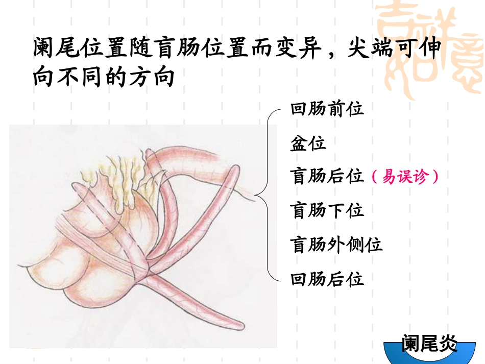 急性阑尾炎讲义_第3页