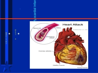 急性心肌梗死AMI