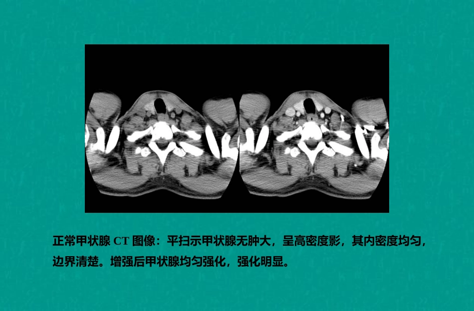 甲状腺影像诊断_第3页