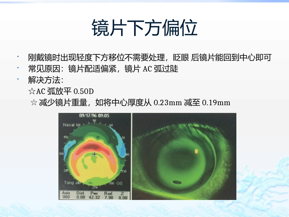 角膜塑形镜的常见问题处理_第2页