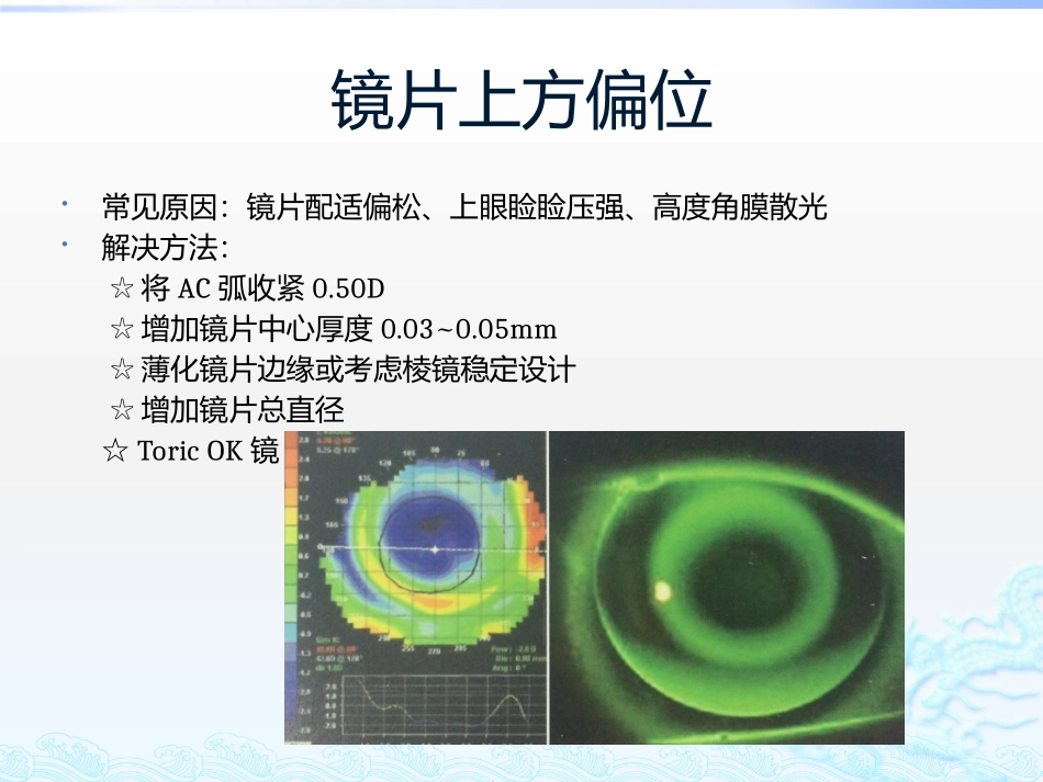 角膜塑形镜的常见问题处理_第3页