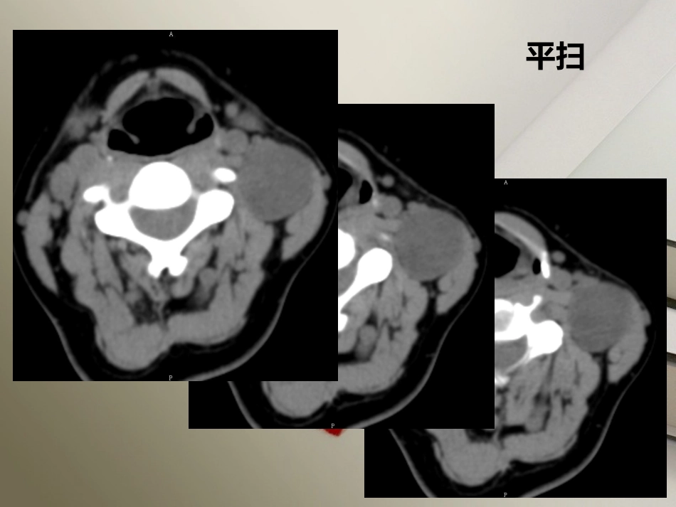 颈部神经鞘瘤_第2页