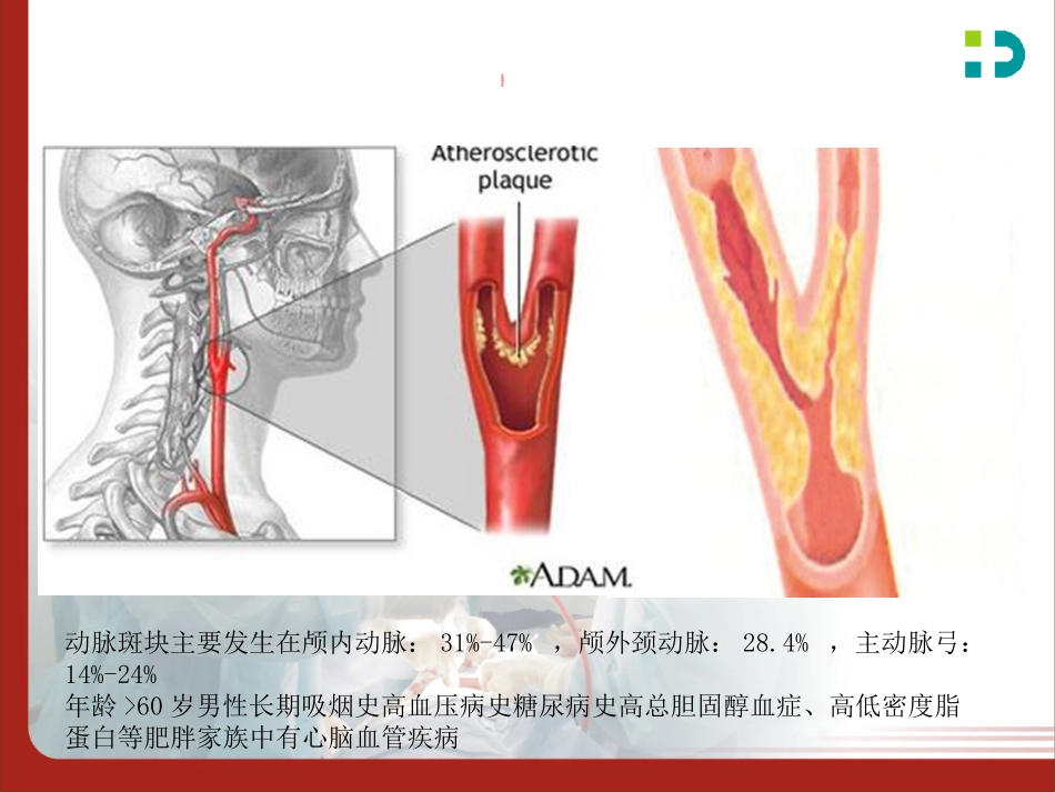 颈动脉斑块的识别与处理_第3页