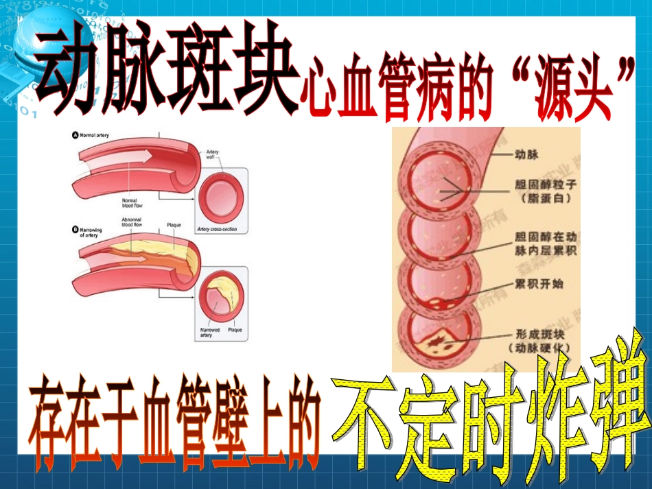 颈动脉斑块专题_第1页