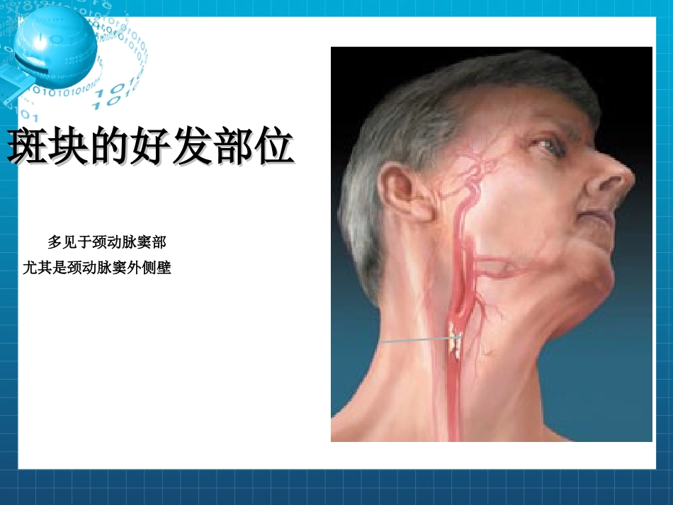 颈动脉斑块专题_第3页