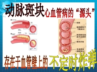 颈动脉斑块专题