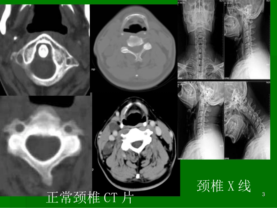 颈椎病教学PPT课件_第3页