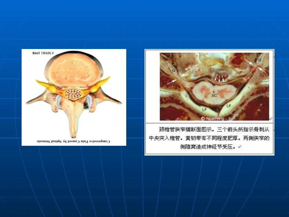颈椎管狭窄症讲义_第3页