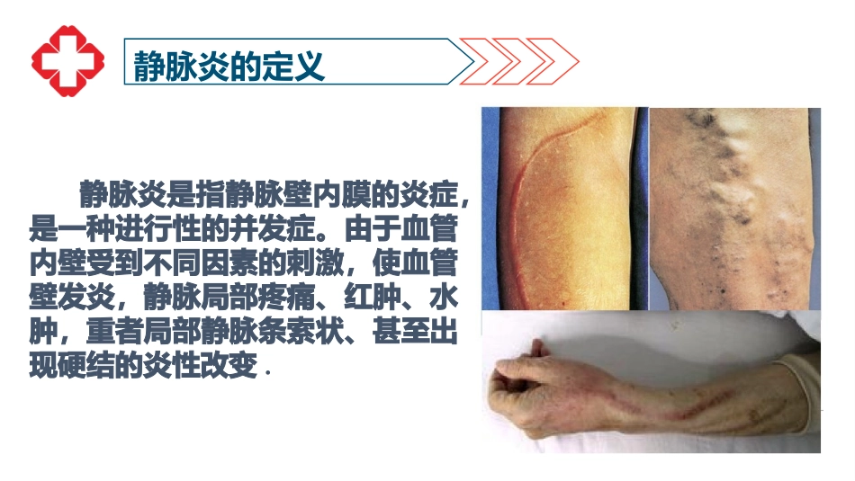 静脉炎的护理要点_第3页