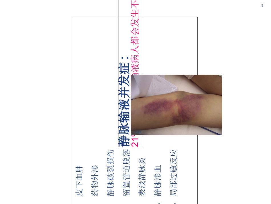 静脉炎的预防和处理优质课件_第3页
