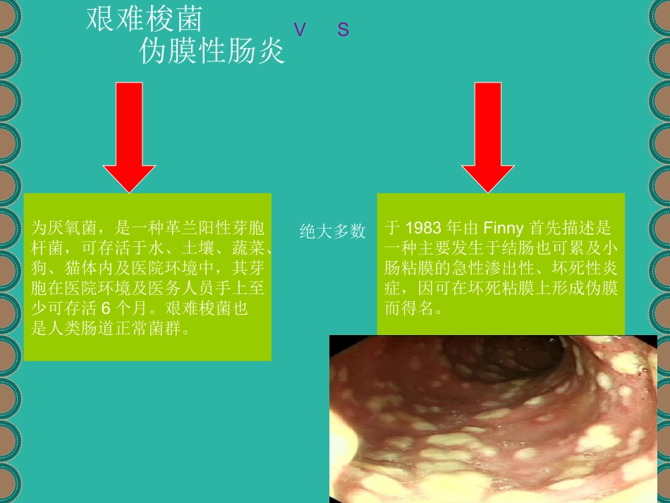 抗生素相关性艰难梭菌伪膜性肠炎优质课件_第2页