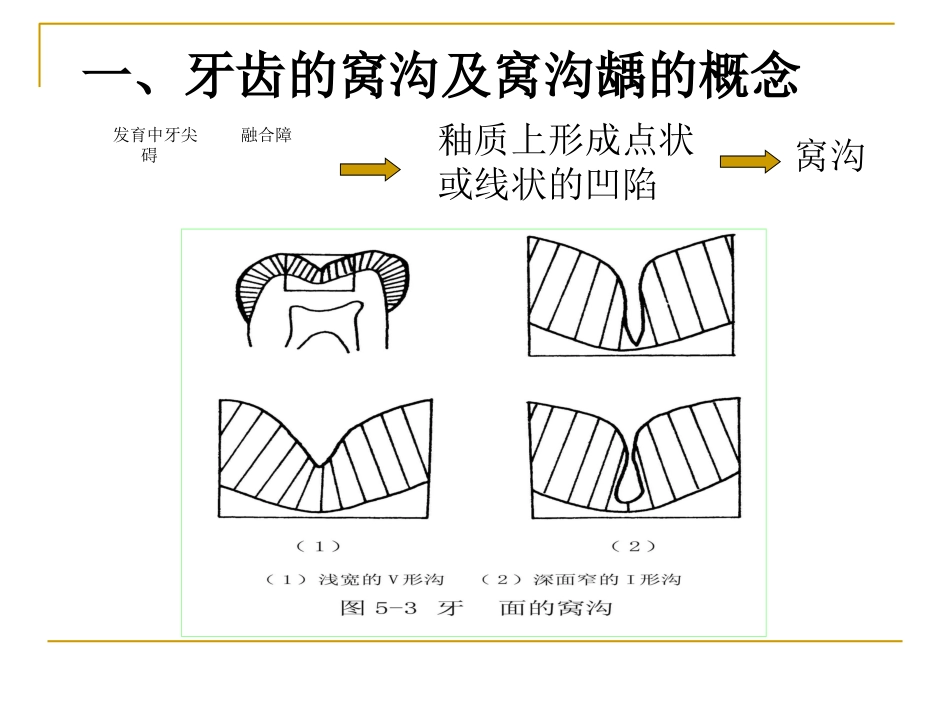 口腔窝沟封闭的方法及步骤_第2页