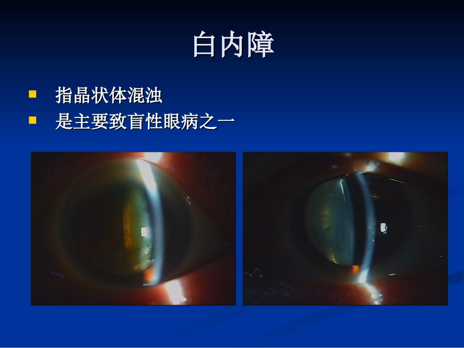 老年性白内障培训课件_第2页