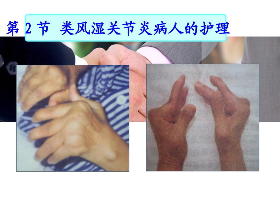 类风湿关节炎病人的护理_第2页