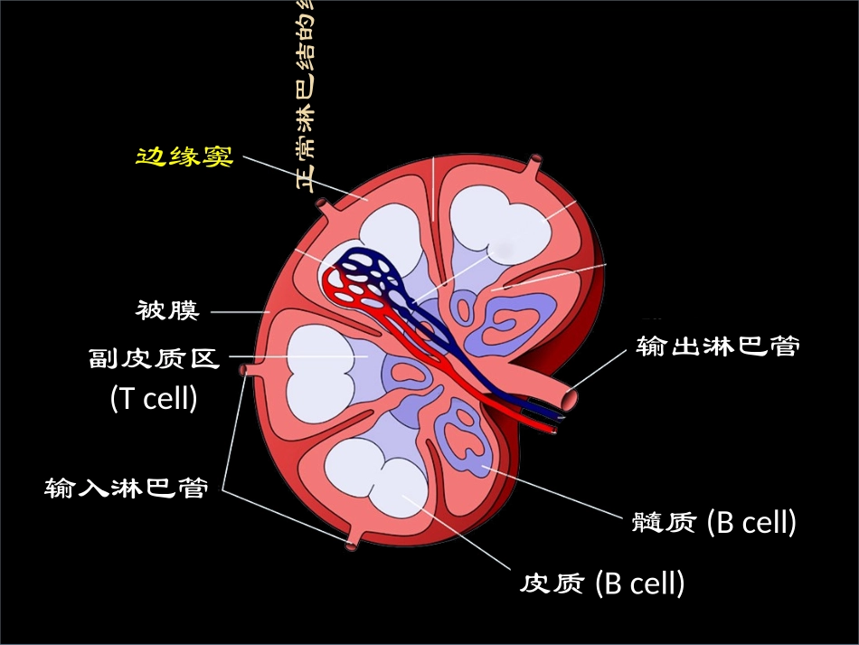 淋巴造血系统淋巴瘤讲解材料_第3页