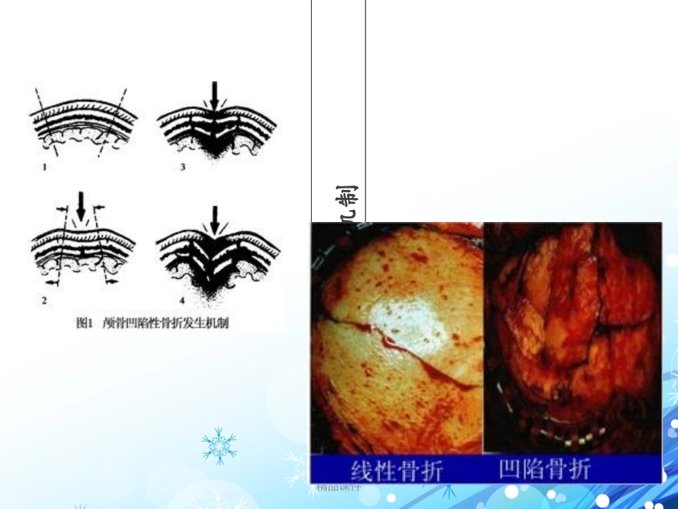 颅骨骨折护理查房_第3页