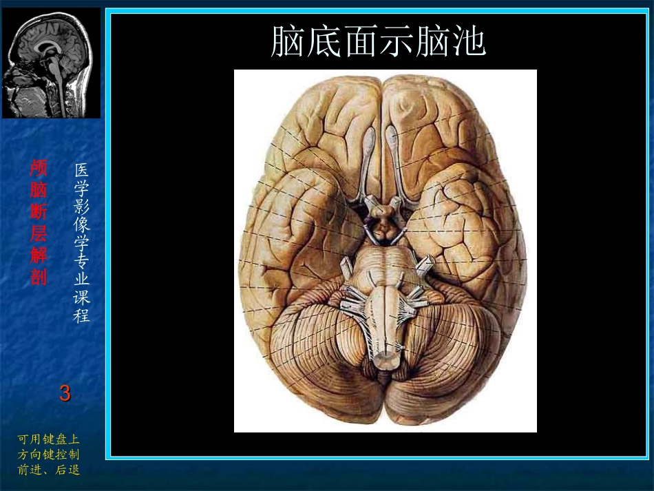 脑池CT影像解剖_第3页