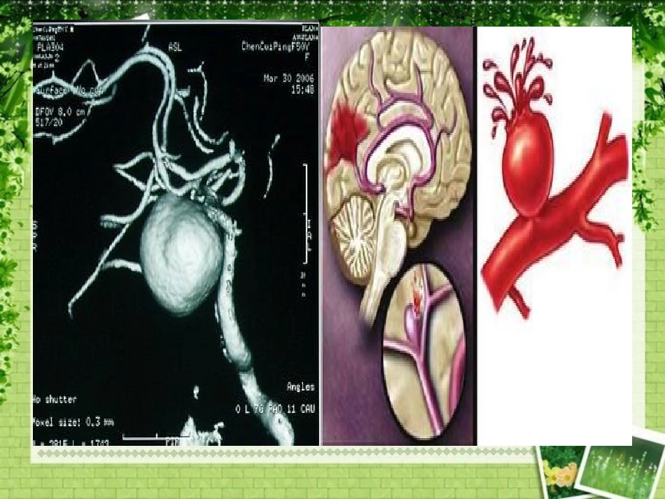 脑出血的急救优质课件_第2页