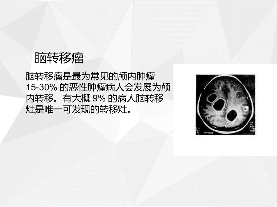 脑转移瘤医学课件_第2页