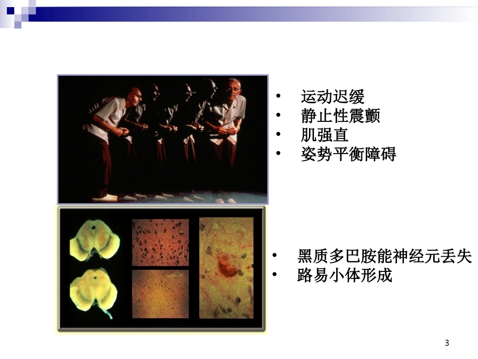 帕金森病中医药治疗探索_第3页