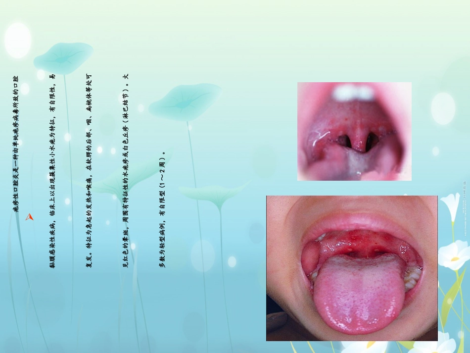 疱疹性咽峡炎(3)_第2页