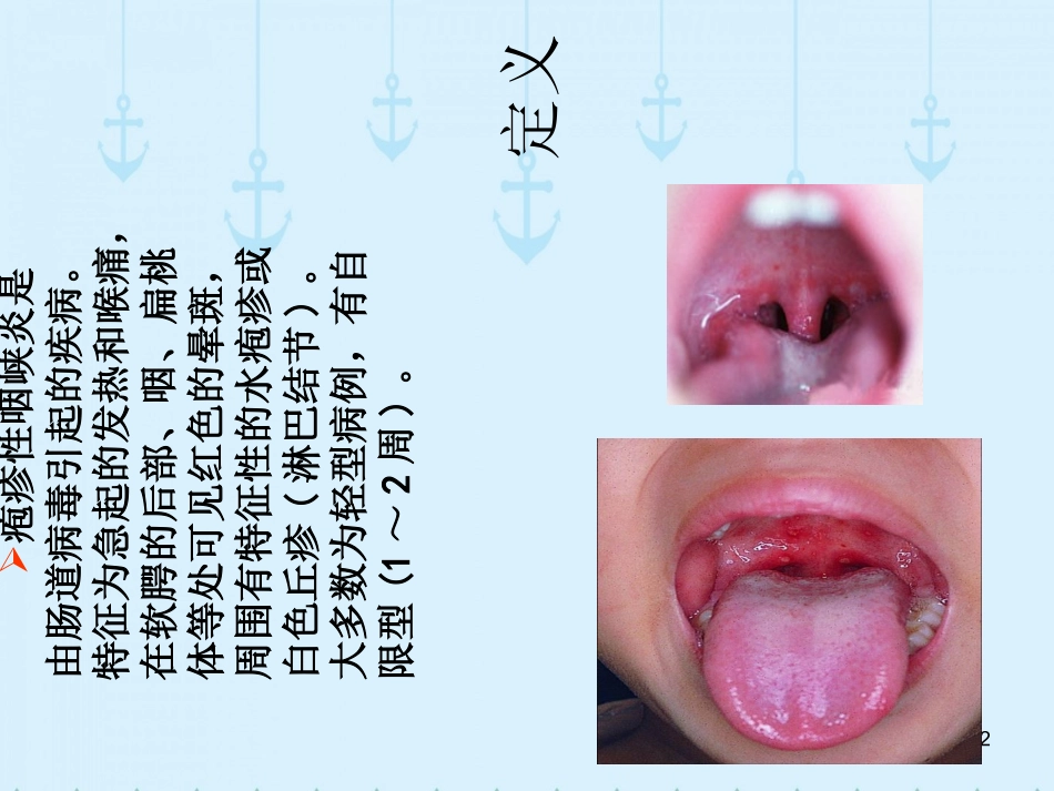 疱疹性咽峡炎_第2页