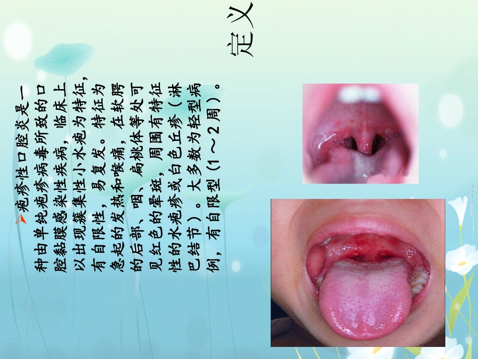 疱疹性咽峡炎优质课件_第2页