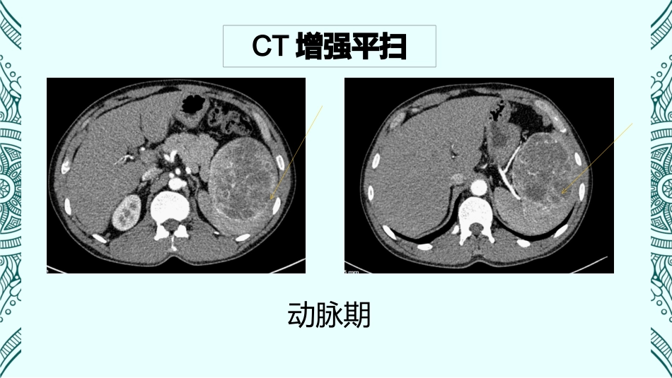 脾脏窦岸细胞血管瘤影像病例讨论_第3页