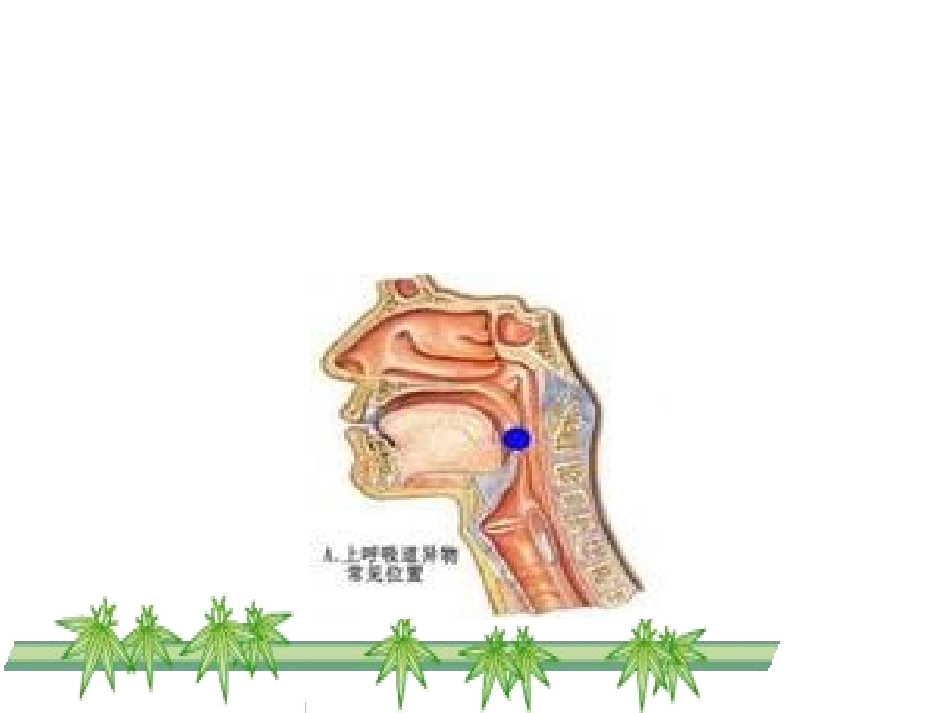 气道异物梗阻急救技术课件_第2页