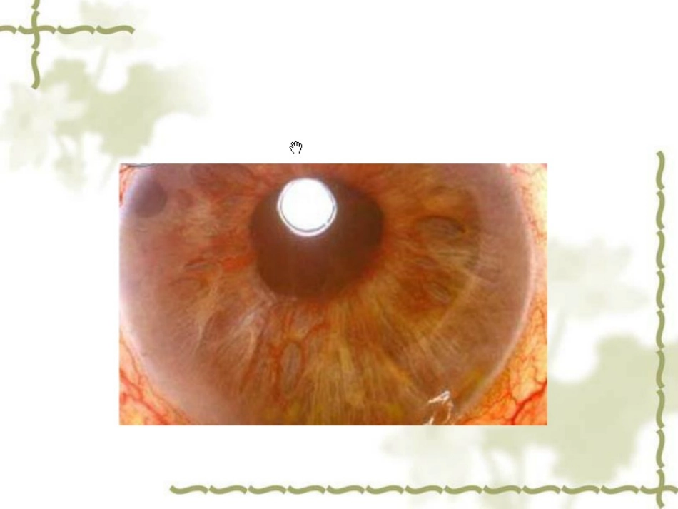 青光眼护理查房_第3页