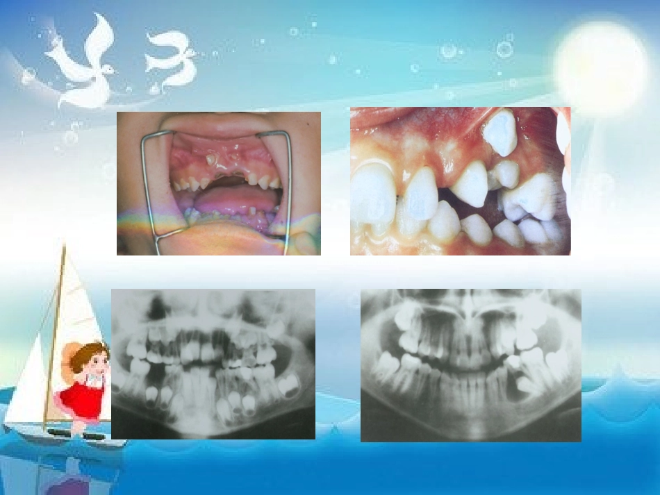 乳牙的根管治疗_第3页