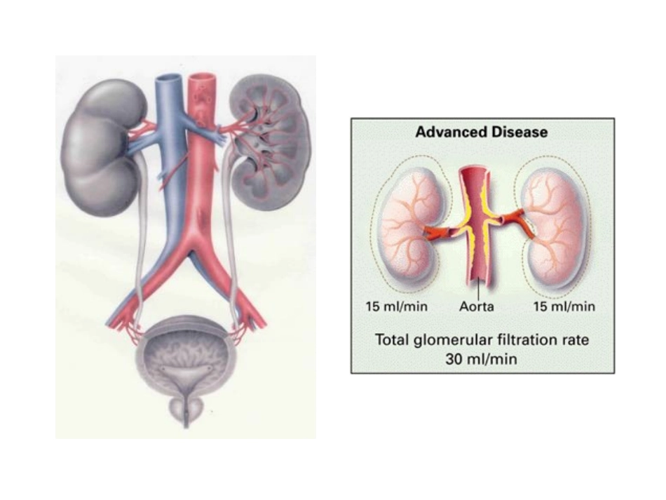 肾动脉狭窄的诊断与治疗优质课件_第2页