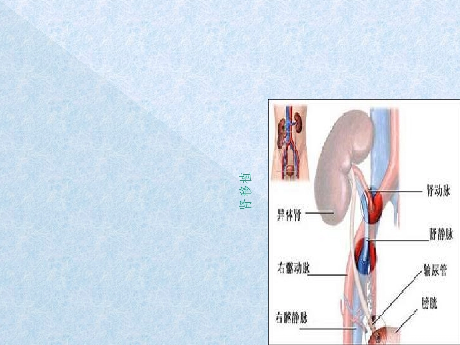 肾移植的护理_第3页