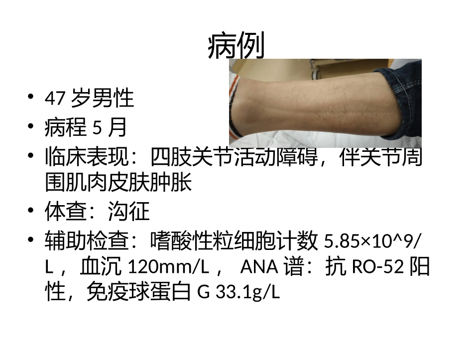 嗜酸性粒细胞增多症_第2页